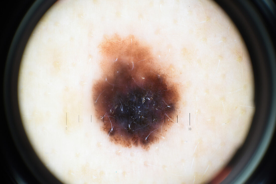 Dysplastic naevus, dermascope image