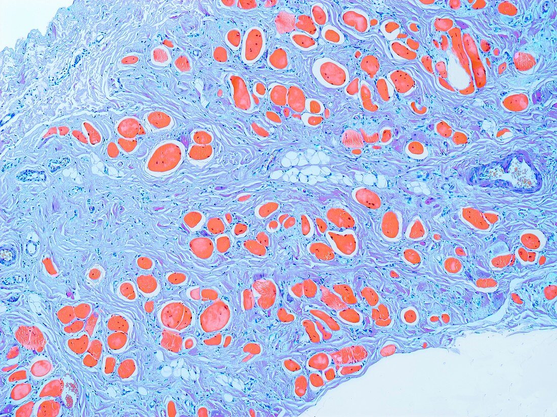 Muscular dystrophy, LM