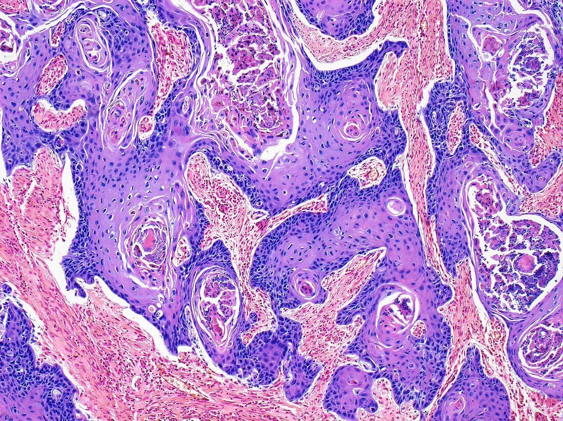 Squamous cell carcinoma of the vulva, LM