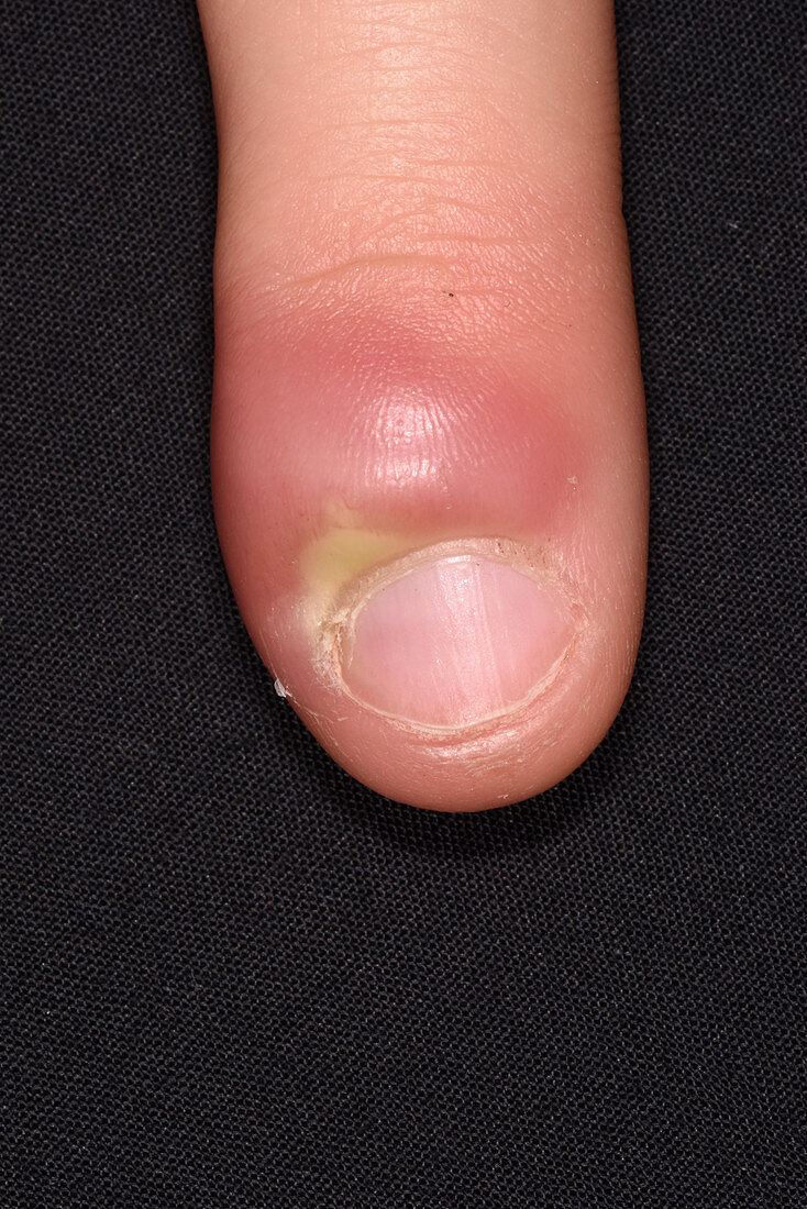 Paronychia infection