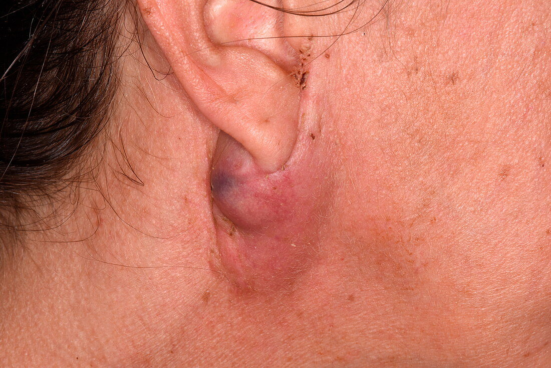 Seroma after excision of a tumour