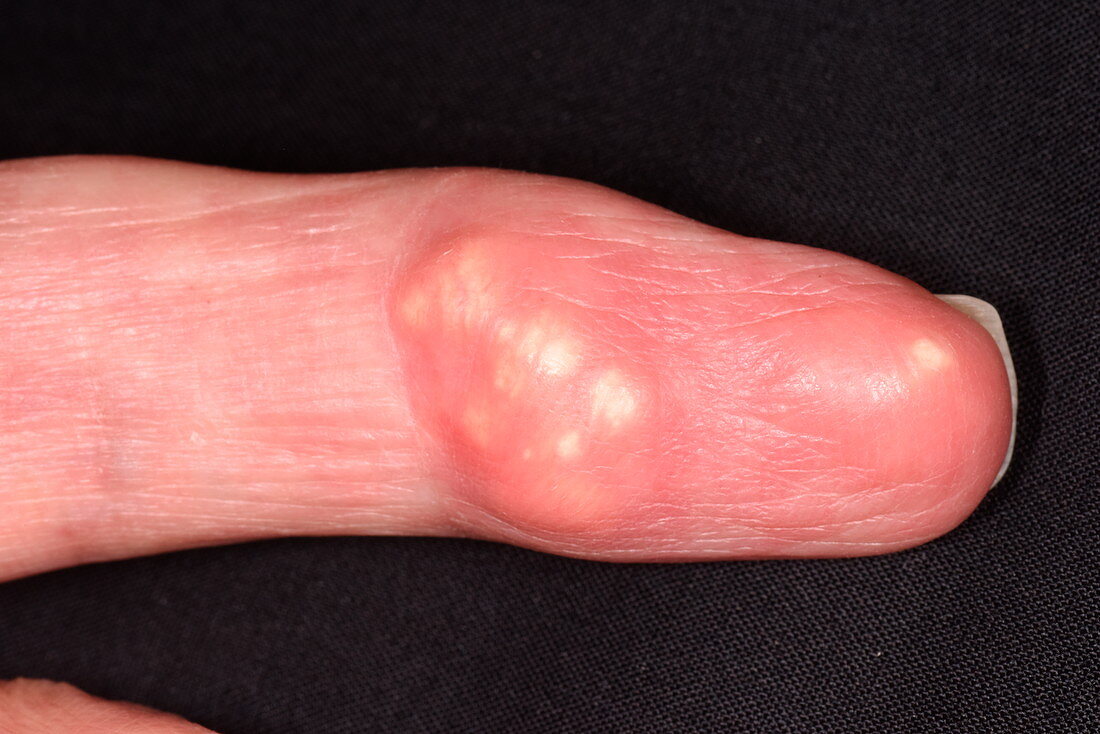 Gout in the finger
