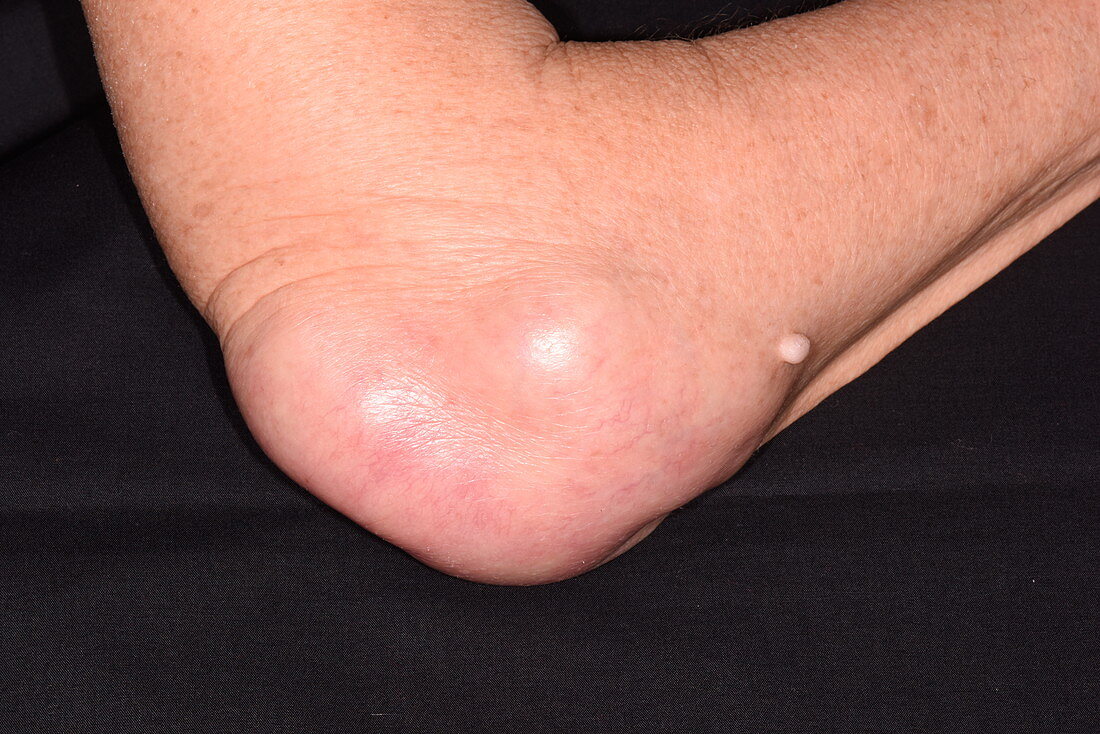 Bursitis of the elbow