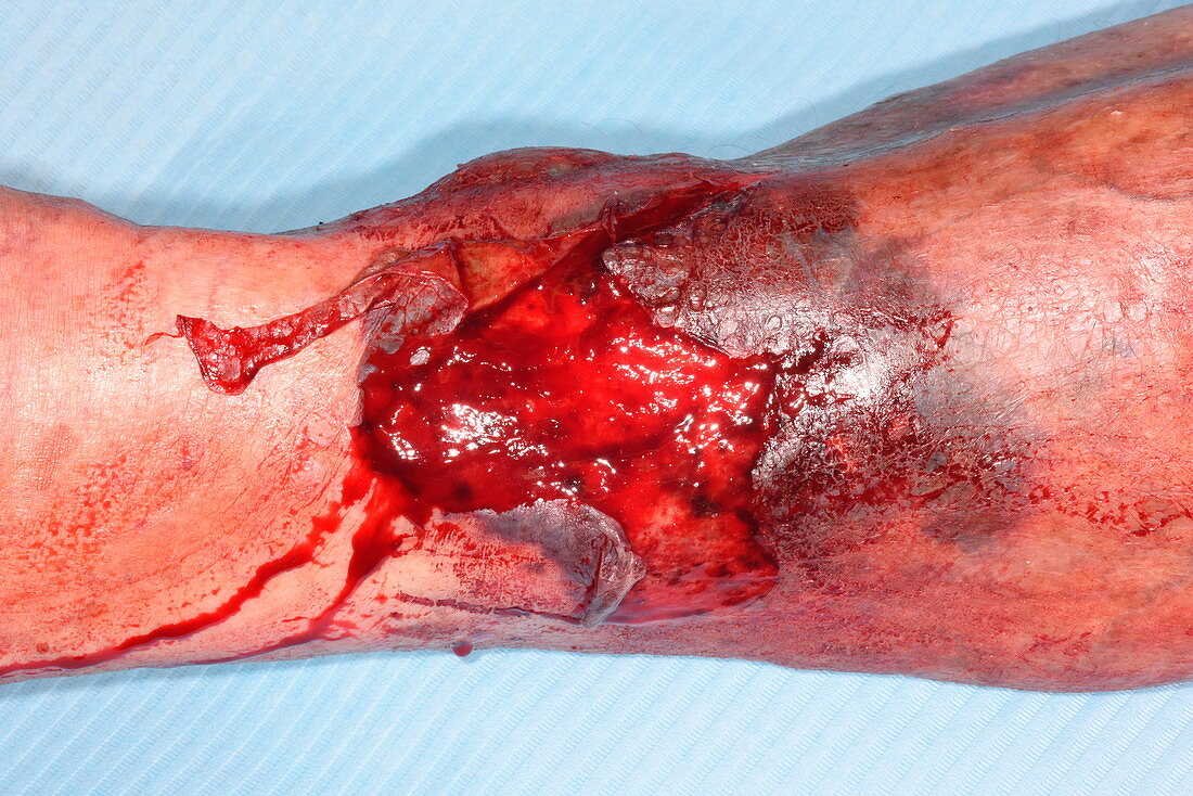 Wound and haematoma on leg