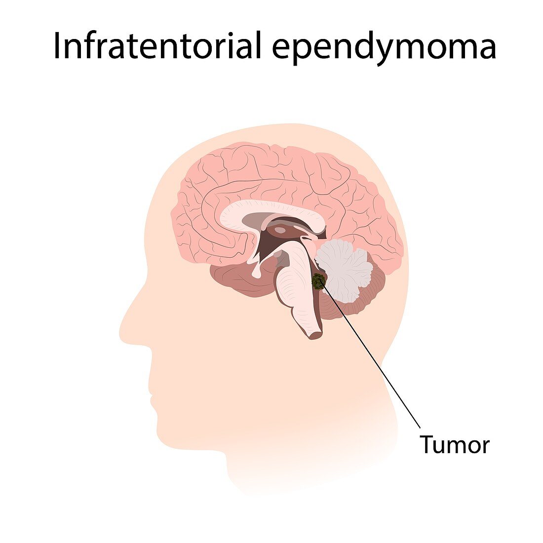 Infratentorial ependymoma, illustration