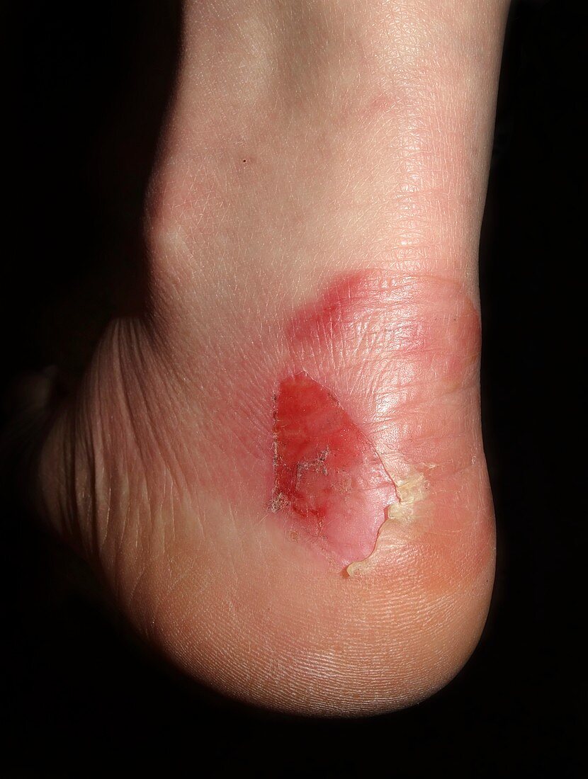 Blister and bruising from ill-fitting boots