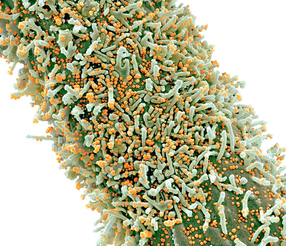 Cell infected by Covid-19 virus particles, SEM