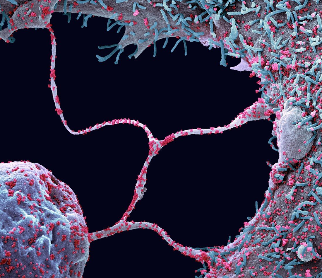 Cells infected by Covid-19 virus particles, SEM