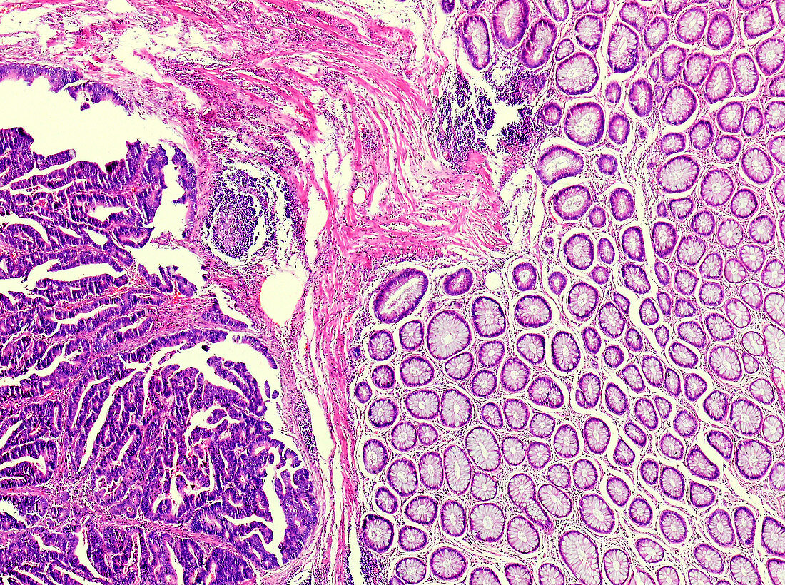 Carcinoid tumour of the colon, light micrograph