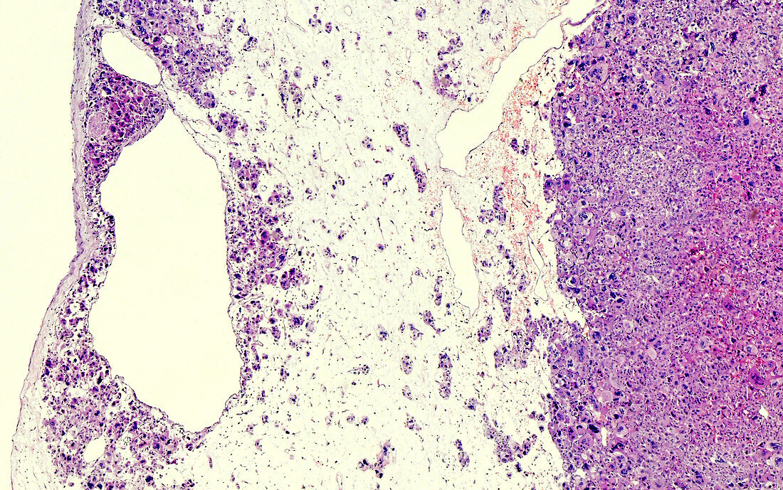 Adrenal cortical cancer, light micrograph