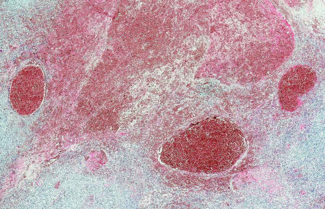 Spindle cell sarcoma, light micrograph