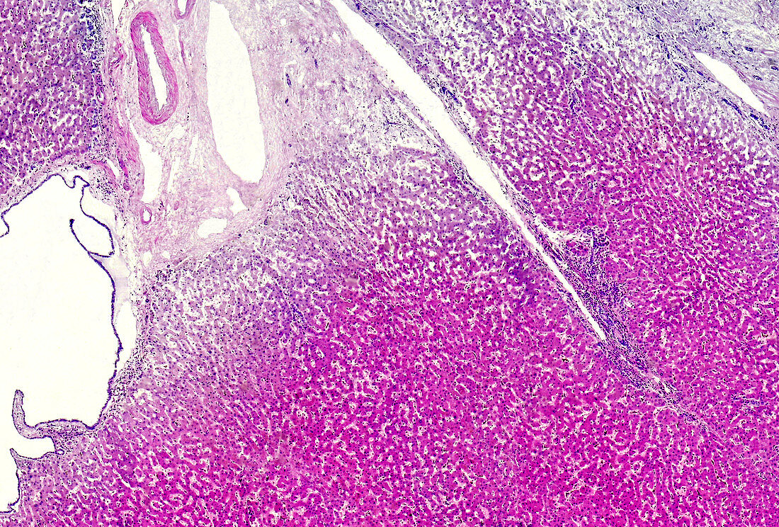 Simple liver cyst, light micrograph