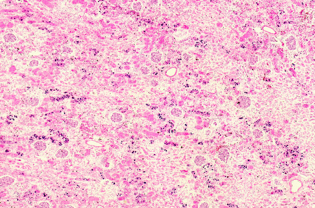 Mercuric chloride in the human kidneys, light micrograph