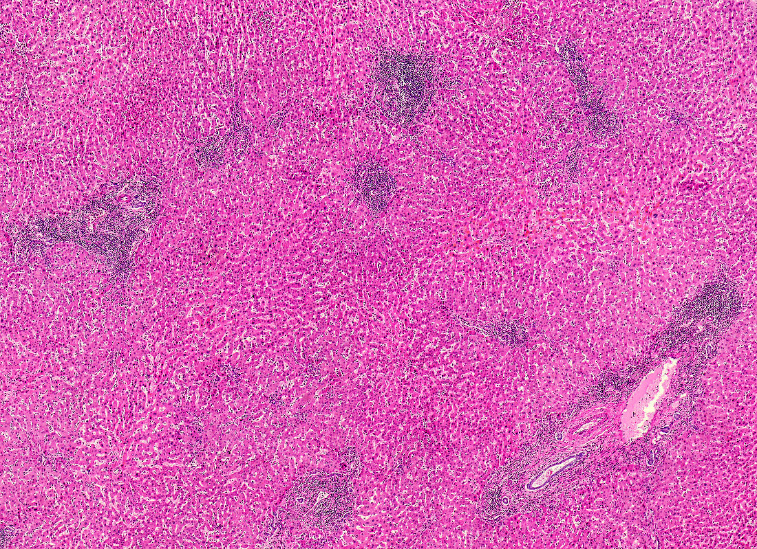 Sarcomatoid carcinoma, light micrograph