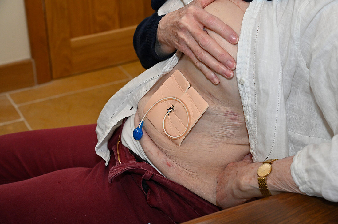 Patient with dressing applied after a chest drain