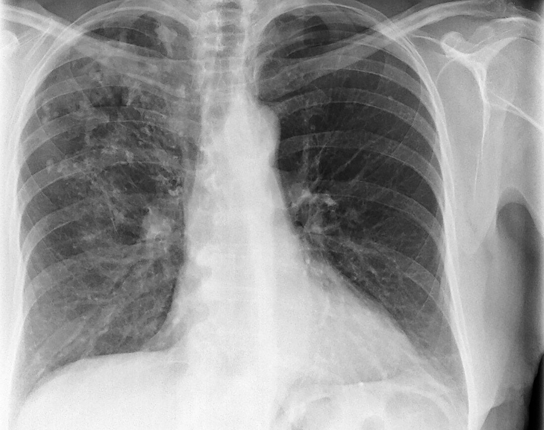Tuberculosis scarring, X-ray