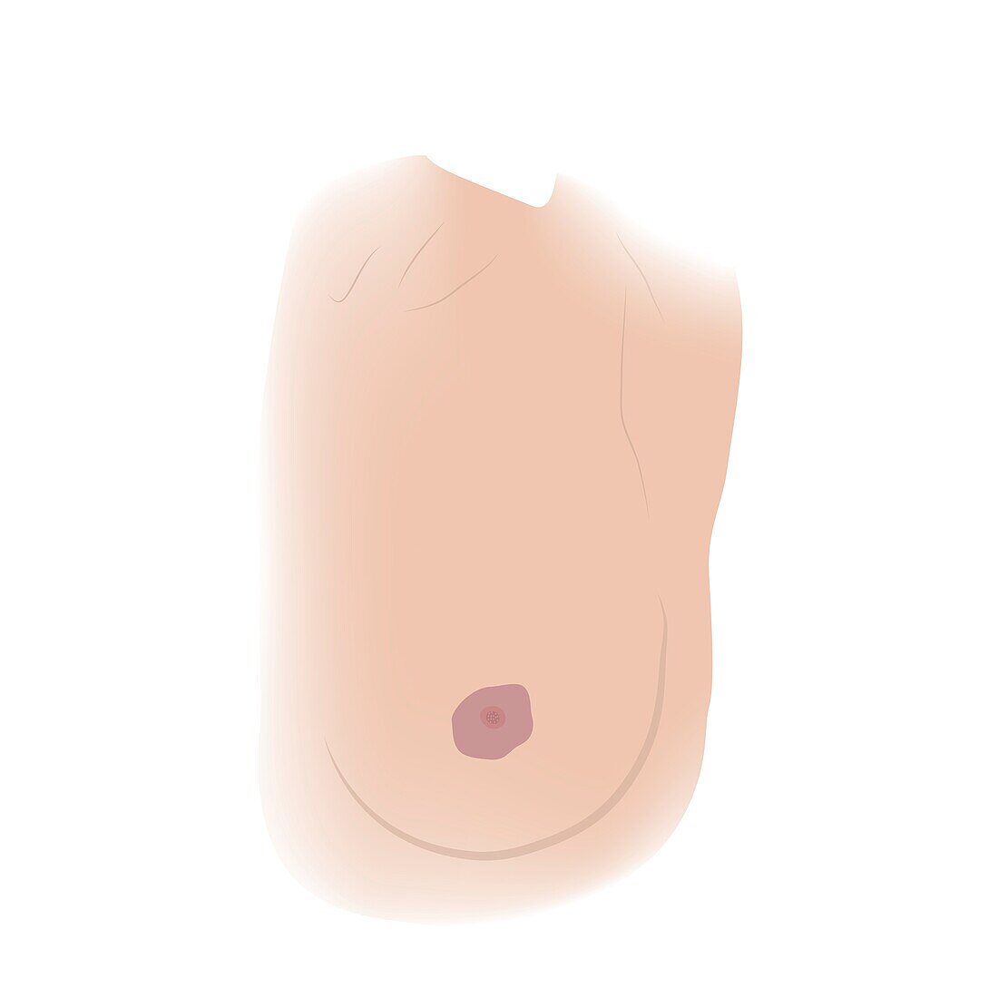 Changes in nipple shape, illustration