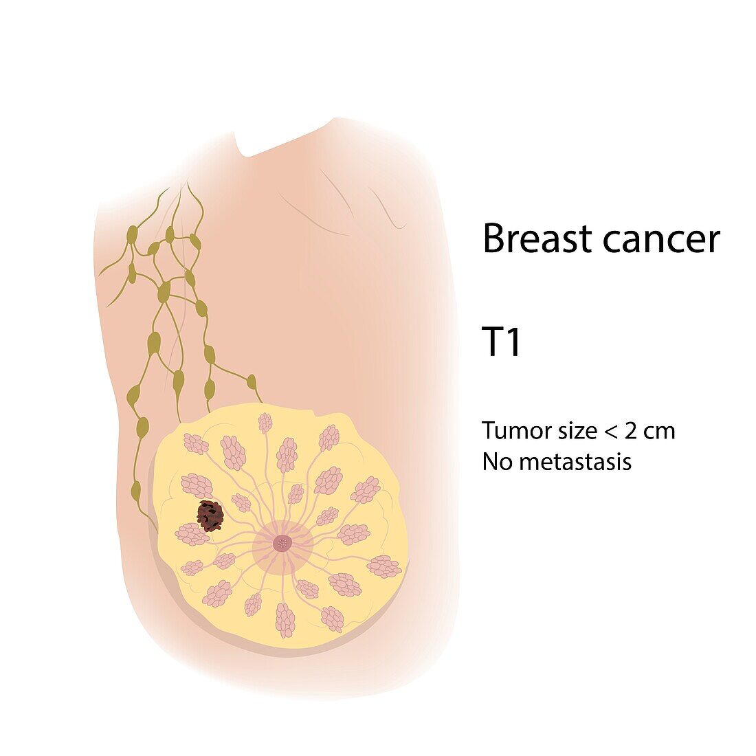 Breast cancer at stage T1, illustration