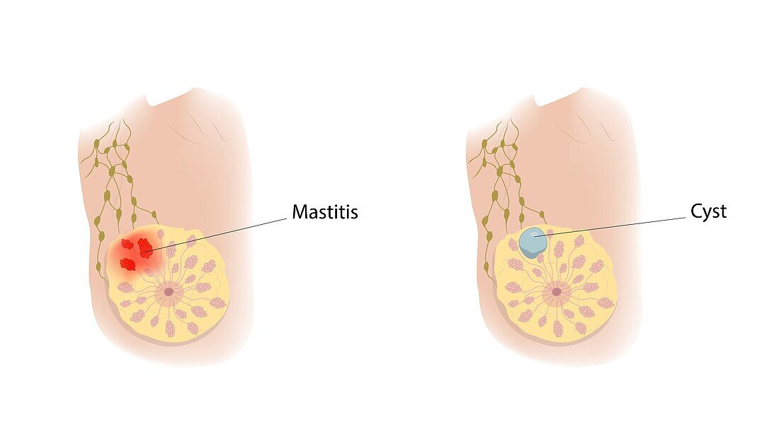 Mastitis and cyst, illustration