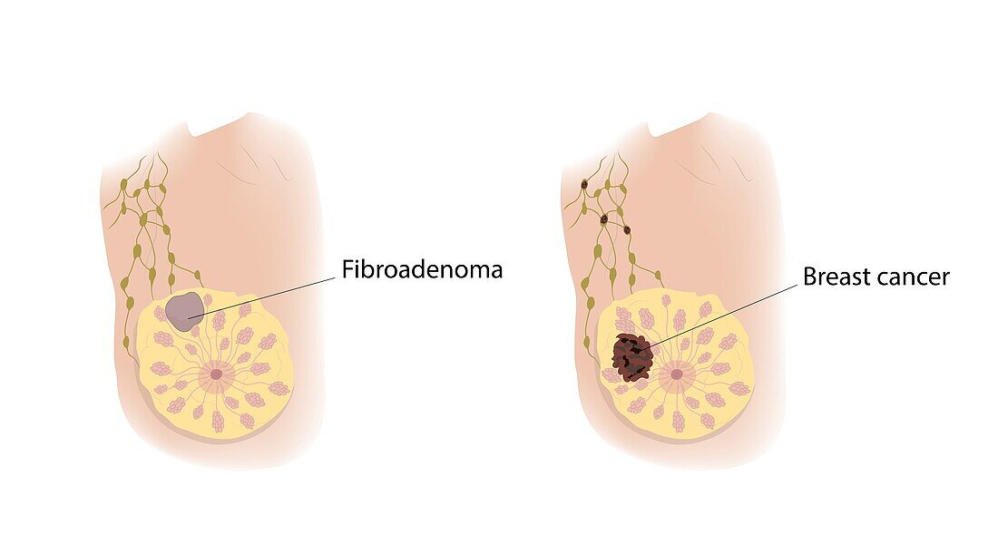 Fibroadenoma and breast cancer, illustration