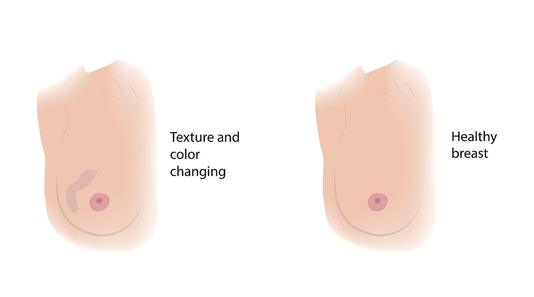 Healthy breast and texture and colour change, illustration