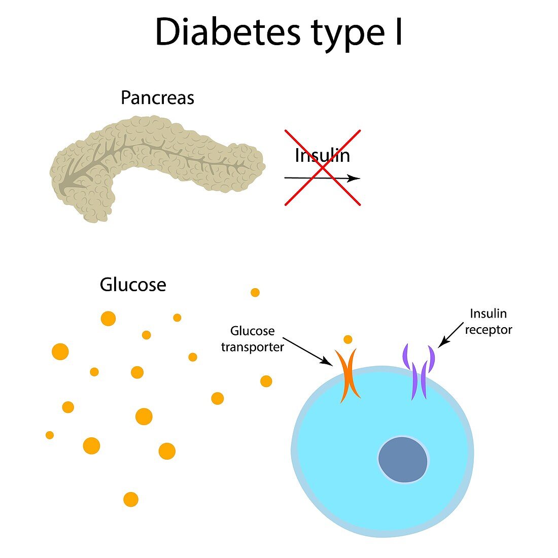 Diabetes type 1, illustration