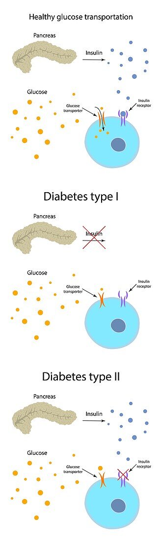 Diabetes and healthy glucose metabolism, illustration