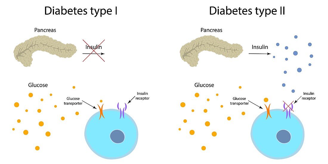 Diabetes type 1 and 2, illustration
