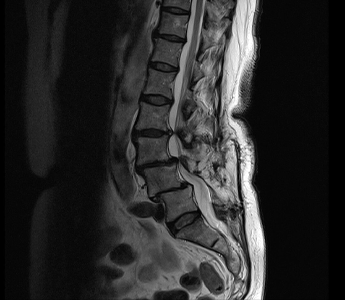 Spinal stenosis, MRI scan