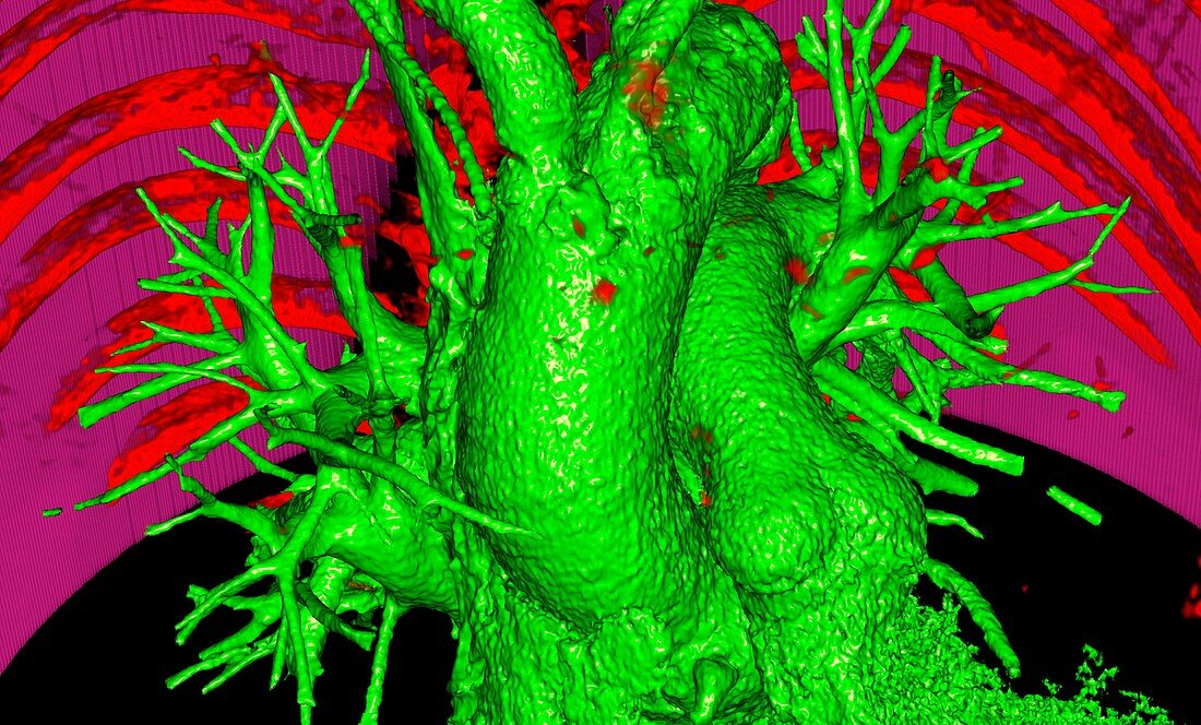 Aorta and pulmonary artery, 3D CT scan