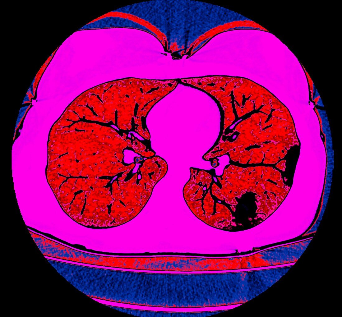 Lungs affected by Covid-19 pneumonia, CT scan