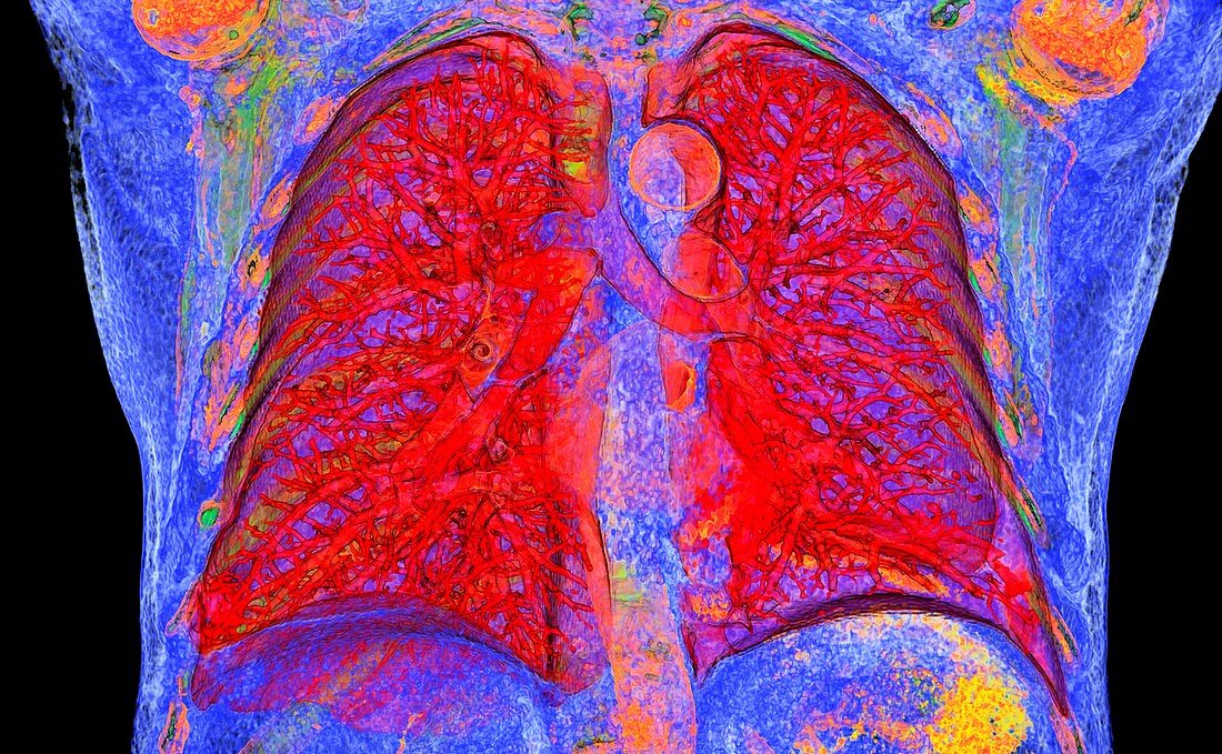 Healthy lungs, 3D CT scan