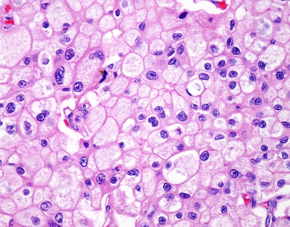 Chromophobe renal cell carcinoma, light micrograph