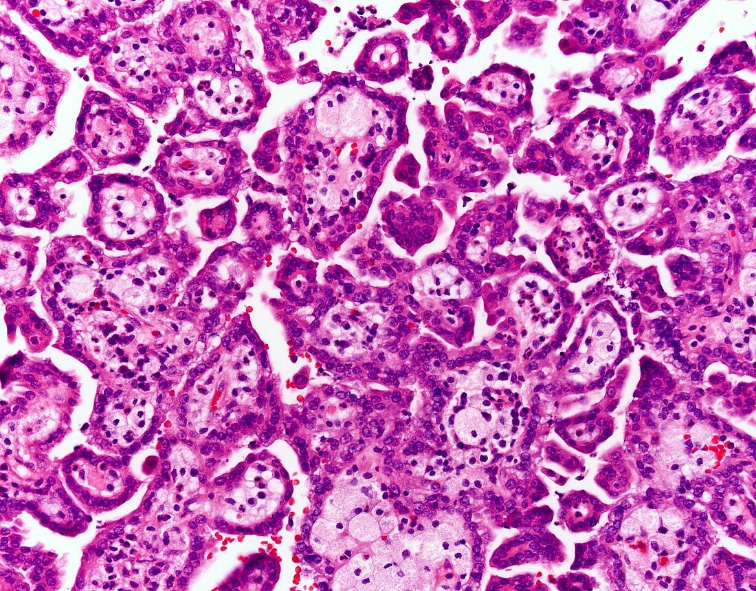 Papillary renal cell carcinoma, light micrograph