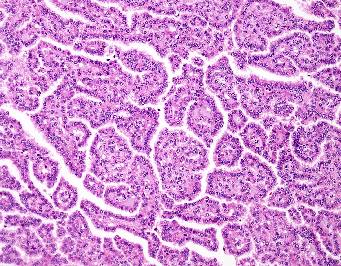 Papillary renal cell carcinoma, light micrograph
