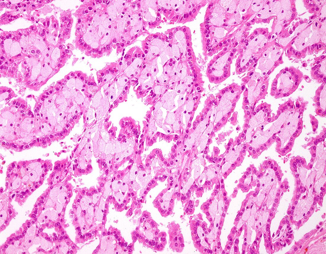 Papillary renal cell carcinoma, light micrograph