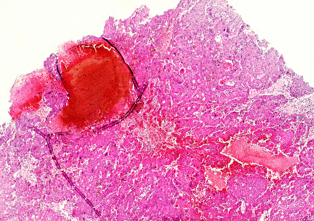 Endocrine tumour, light micrograph