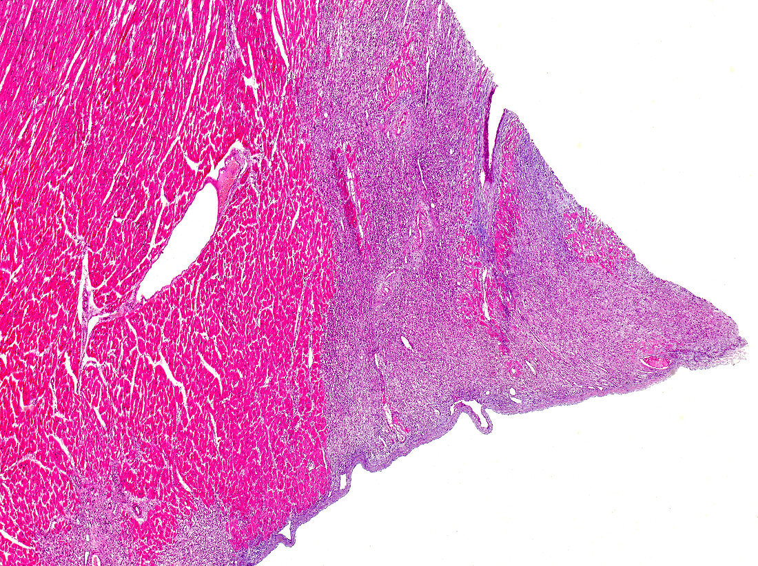 Infective myocarditis, light micrograph