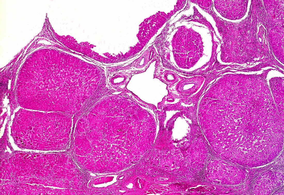 Liver cirrhosis in Wilson's disease, light micrograph