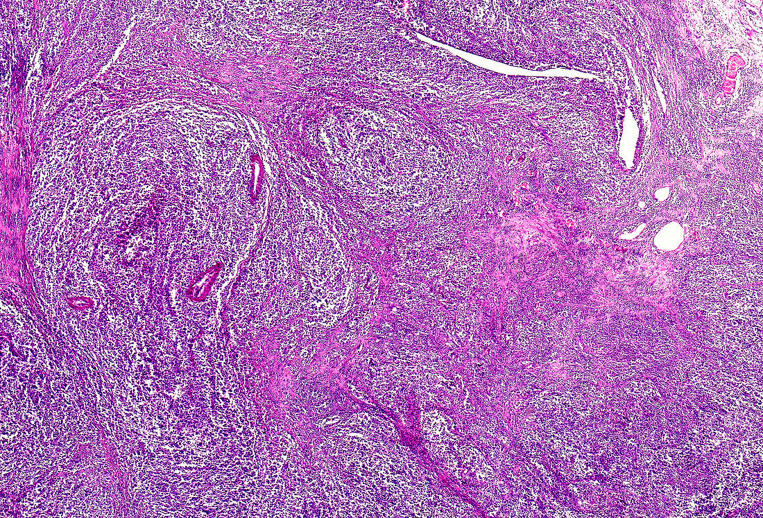 Pernicious anaemia of the stomach, light micrograph
