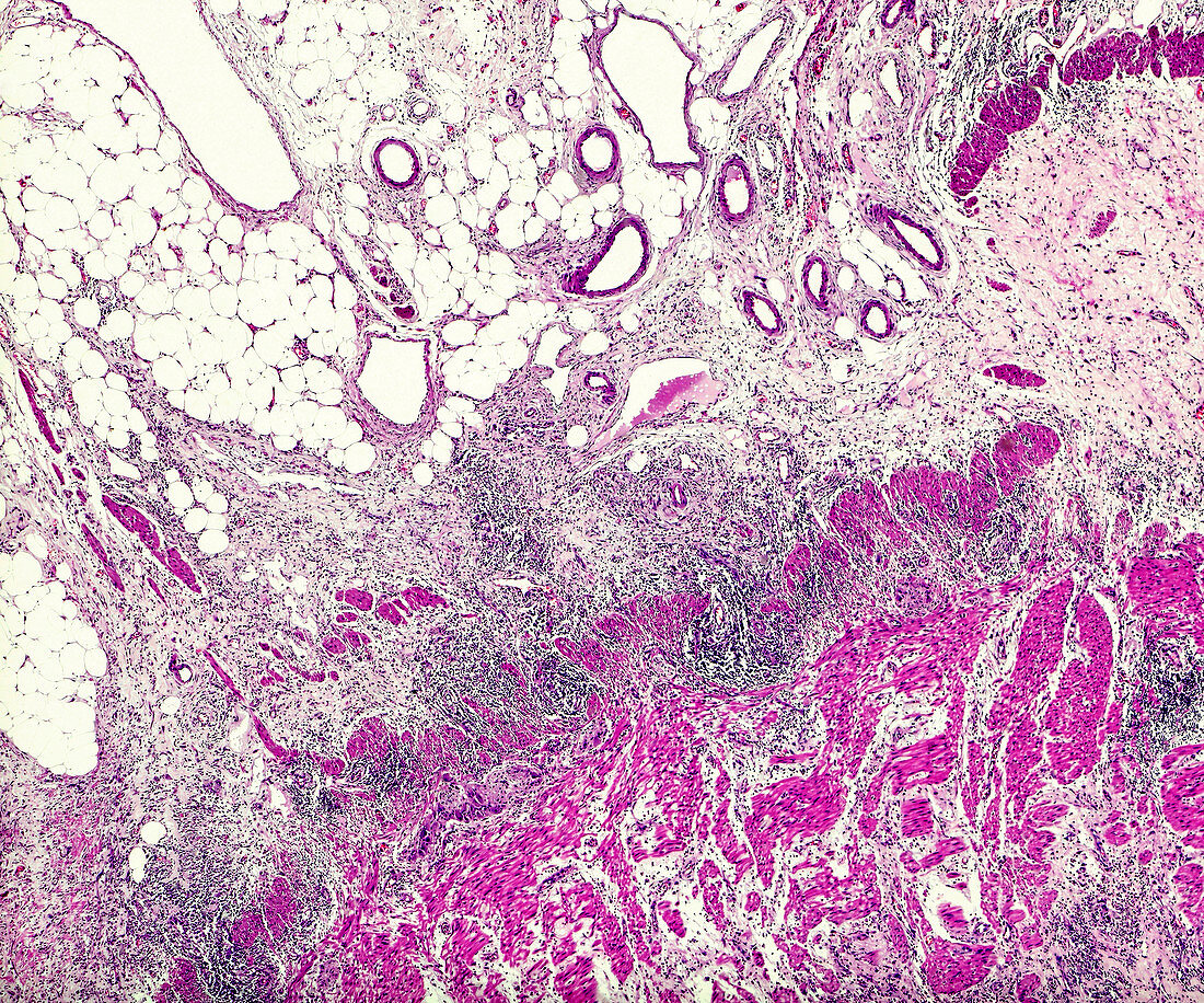 Crohn's disease, light micrograph