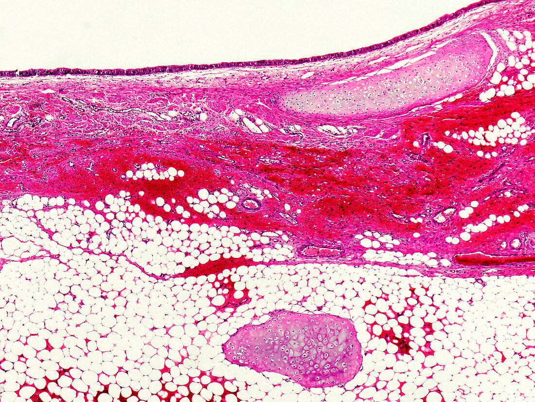 Dermoid ovarian cyst, light micrograph