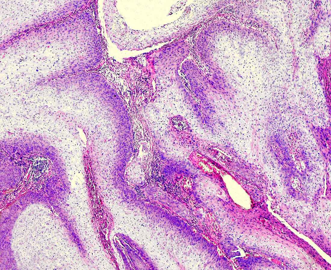Penile skin cancer, light micrograph