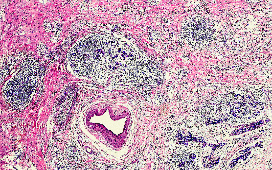 Pyogenic granuloma, light micrograph