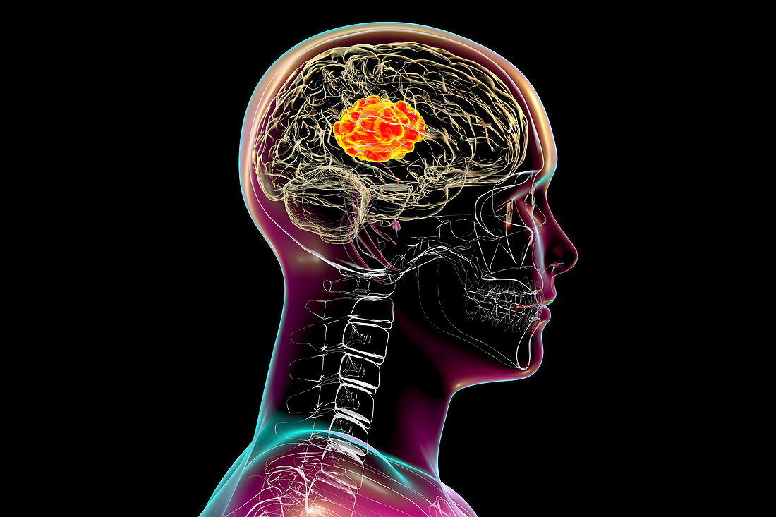 Brain mucormycosis, illustration