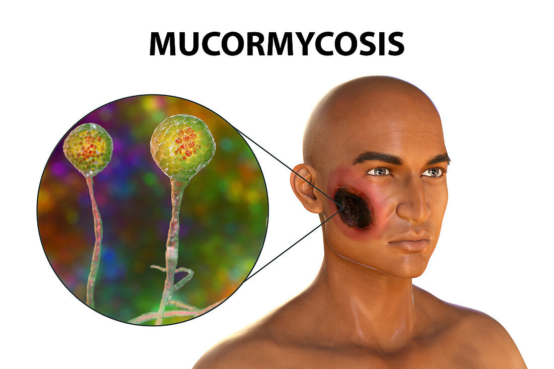 Cutaneous mucormycosis, illustration