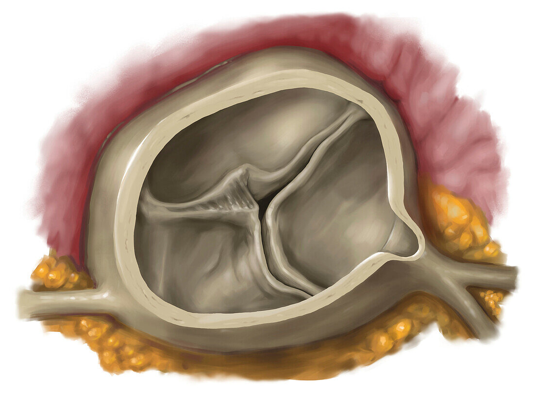 Aortic valve stenosis, illustration