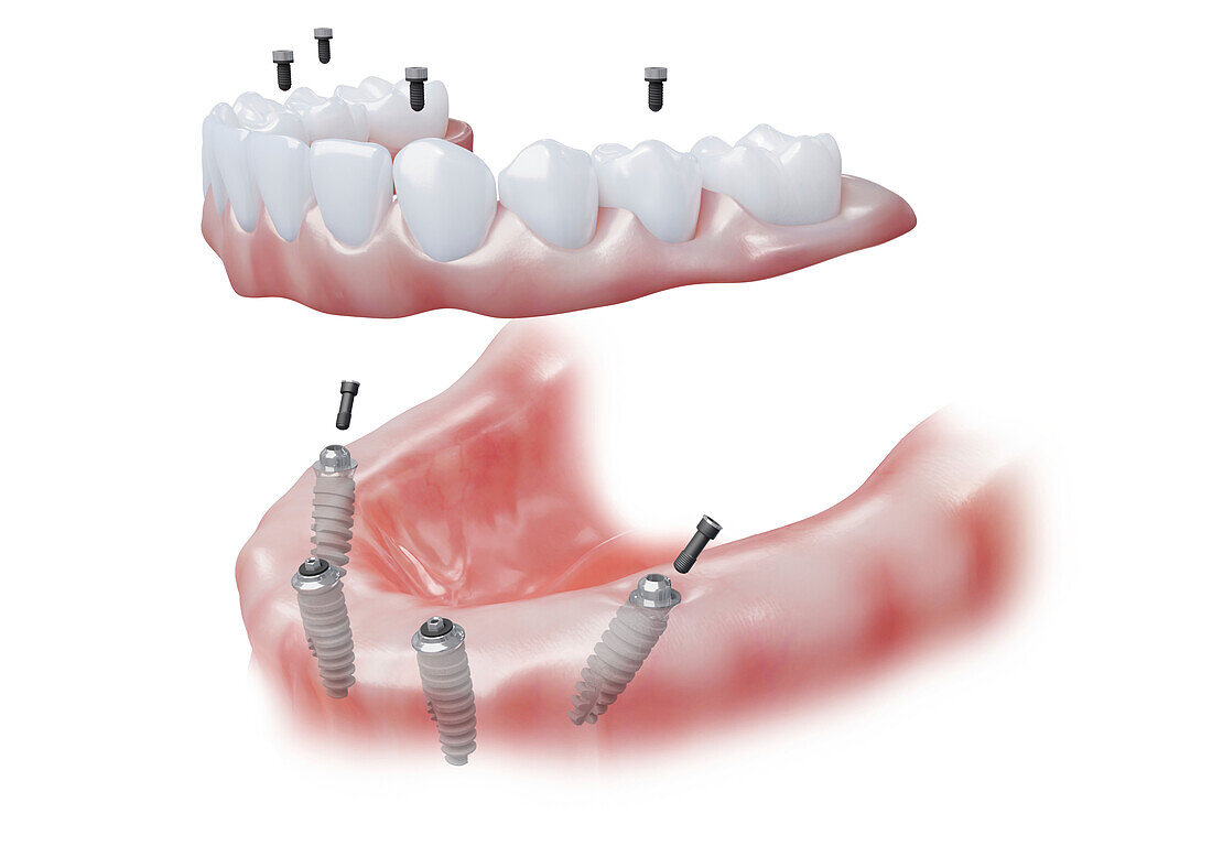 All-on-four prosthodontics, illustration