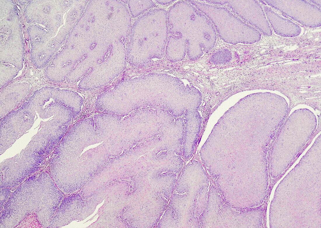 Foreskin genital wart, light micrograph
