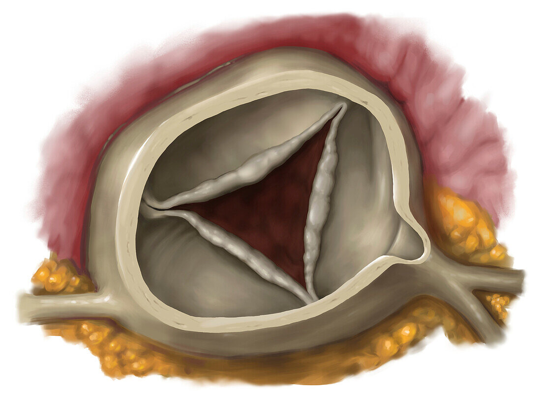 Aortic insufficiency, illustration